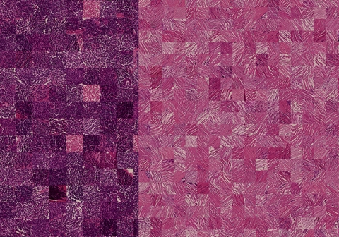 Breast Cancer image